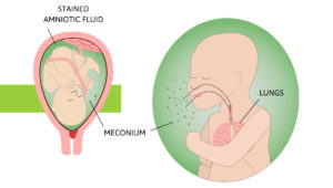 Meconium fluid
